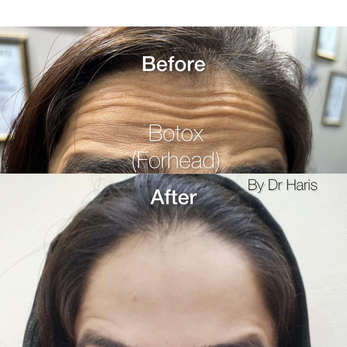 Botox